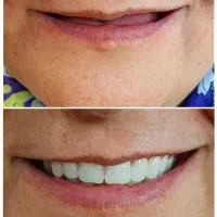 دندان مصنوعی و دندانسازی ، خدمات دندان سازی|خدمات آرایشگری و زیبایی|مشهد, شفا|دیوار