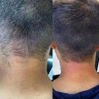 جدیدترین دستگاه لیزر 2025 در شهر جم|خدمات آرایشگری و زیبایی|جم, |دیوار