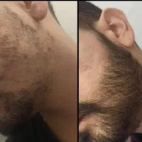 سرم افزایش ریش و تو تقویت کننده