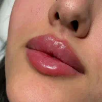 مدل ژل و بوتاکس