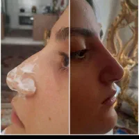 خدمات ژل بوتاکس مزو فیلر انزیم بوتاکس|خدمات آرایشگری و زیبایی|تهران, تهرانسر مرکزی|دیوار