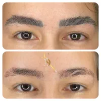 پاک کردن تتو ، ریمو تاتو کلینیک سلطانی