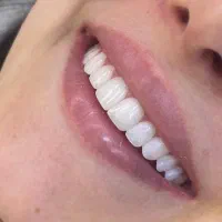 کامپوزیت ونیر آلمانی|خدمات آرایشگری و زیبایی|تهران, چیذر|دیوار