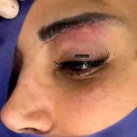 جراحی بلفاروپلاستی نوین