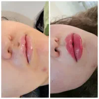 بوتاکس ژل نخ چالگونه مزو انزیم فیلر