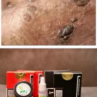 بهبودی زگیل تناسلی بدون نیاز به فریز