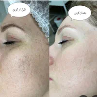 پاککردن تتوی بدن و روشن شدن بیکینی و زیربغل وصورت|خدمات آرایشگری و زیبایی|یاسوج, |دیوار