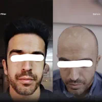 اقساطی/کاشت مو تضمینی/کاشت ابرو/ژل لب