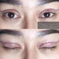 جشنواره تخفیف بلفاروپلاستی(جراحی پلک)|خدمات آرایشگری و زیبایی|شاهینشهر, فردوسی|دیوار