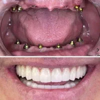 جشنواره دندانپزشکی ایمپلنت ۱۰/۳۰۰|خدمات آرایشگری و زیبایی|سلماس, |دیوار