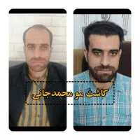کاشت مو و ابرو و ریش|خدمات آرایشگری و زیبایی|ارسنجان, |دیوار