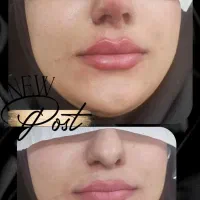 ژل بوتاکس خالبرداری|خدمات آرایشگری و زیبایی|زابل, |دیوار