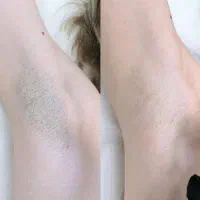 تخفیف لیزر موهای زائد تا آخر هفته  ۳۹۰ تومان|خدمات آرایشگری و زیبایی|کرج, گوهردشت|دیوار