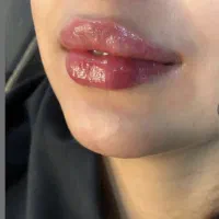 ژل و بوتاکس فیلر مزو پی ارپی آنزیم هایفو بلفارو