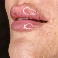 فیلر.بوتاکس.ژل