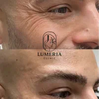 خدمات بوتاکس و مزونیدیلینگ صورت برای اقا و خانم