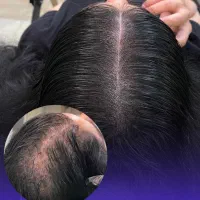 میکرواسکالپ اسکراپ کاشتمو درمجموعه زیبانو