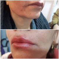 لیزرتاتوبوتاکس بیوفیلرالکترولیزخال لیزرموی پرسینگ|خدمات زیبایی و سلامت|اهواز, کیانپارس |دیوار