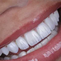ایمپلنت  ،زیبایی با اقساط و تخفیف ویژه
