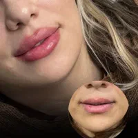 ژل وبوتاکس نقد و اقساط