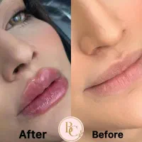 جشنواره فیلر لب بادی بوتاکس فول فیس بلفارو غبغب