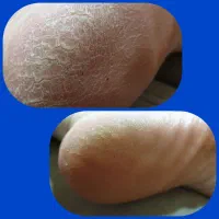 خداحافظی با ترک پا