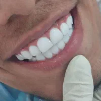 کامپوزیت دندان طرح لبخند جرمگیری بلیچینگ پالیش|خدمات آرایشگری و زیبایی|اهواز, نادری|دیوار