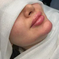 ژل بوتاکس و انزیم|خدمات آرایشگری و زیبایی|شیراز, لشکری‎|دیوار