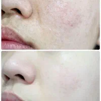 کربکسی تراپی با دستگاه|خدمات آرایشگری و زیبایی|مسجد سلیمان, |دیوار