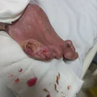 پانسمان نوین زخم بستر / دیابتی / سوختگی / سرطانی|خدمات آرایشگری و زیبایی|ارومیه, |دیوار