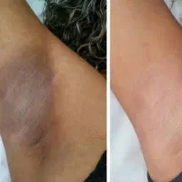 خدمات لیزر و رفع تیرگی و لاغری باتخفیف ویژه