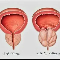 پروستات و مشکلات ج*ن*س*ی آقایان|خدمات آرایشگری و زیبایی|سیرجان, |دیوار
