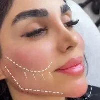 جشنواره ی ۵۰ درصد آف ویژه ی ژل بوتاکس توسط پزشک|خدمات آرایشگری و زیبایی|کرمانشاه, |دیوار