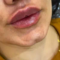 جشنواره تزریق بوتاکس وژل. فیلرکل صورت از ۷میلیون|خدمات آرایشگری و زیبایی|بردسیر, |دیوار