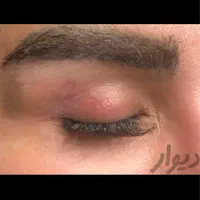 پاک کردن تتو با لیزر کک و مک برداشت خال|خدمات آرایشگری و زیبایی|مشهد, شهید فرامرز عباسی|دیوار