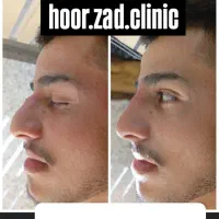 جشنواره ی پاییزه ی فیلر وبوتاکس|خدمات آرایشگری و زیبایی|ارومیه, |دیوار