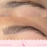 میکروبلیدینگ سوپرنچرال