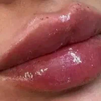 زیبایی و حجم دهی صورت