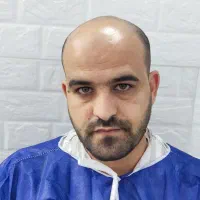 کاشت مو طبیعی به روش سوپر میکروگرفت|خدمات آرایشگری و زیبایی|اهواز, کیانپارس |دیوار