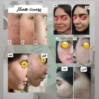 پک ضد جوش تراست