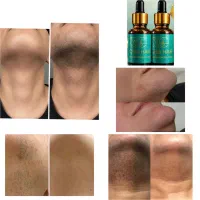 رفع دائمی موهای زائد بدون لیزر