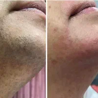 جشنواره لیزر موهای زائد با تیتانیوم پلاس 2025|خدمات آرایشگری و زیبایی|بوشهر, |دیوار