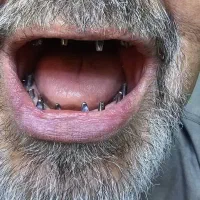 ایمپلنت کره ای ۶/۹۰۰ تخفیف بیشتربا دریافت کدتخفیف|خدمات آرایشگری و زیبایی|تهران, شهرآرا|دیوار