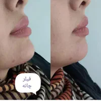 تزریق بوتاکس و ژل در کلینیک(توسط پزشک،)|خدمات آرایشگری و زیبایی|مشهد, هفت تیر (آب و برق)|دیوار