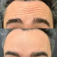 مرکز تخصصی تزریق بوتاکس فیلرگونه چشم زاویه آنزیم|خدمات آرایشگری و زیبایی|اندیشه, اندیشه فاز ۱|دیوار