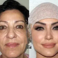 جشنواره اقساطی،بلفارو،ژل بادی،ساکشن غبغب،پی آرپی