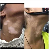 پیسی و پسوریازیس|خدمات آرایشگری و زیبایی|کرمانشاه, |دیوار