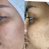 حذف لک و منافذ باز و جای جوش/زیر نظر متخصص پوست|خدمات آرایشگری و زیبایی|مشهد, الهیه|دیوار