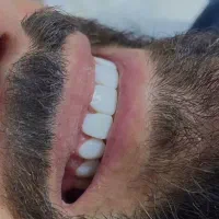 مدل کامپوزیت دندان