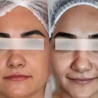 هایفوتراپی رفع چین و چروک پوست با بروزترین تجهیزات|خدمات آرایشگری و زیبایی|شیراز, قدوسی غربی|دیوار